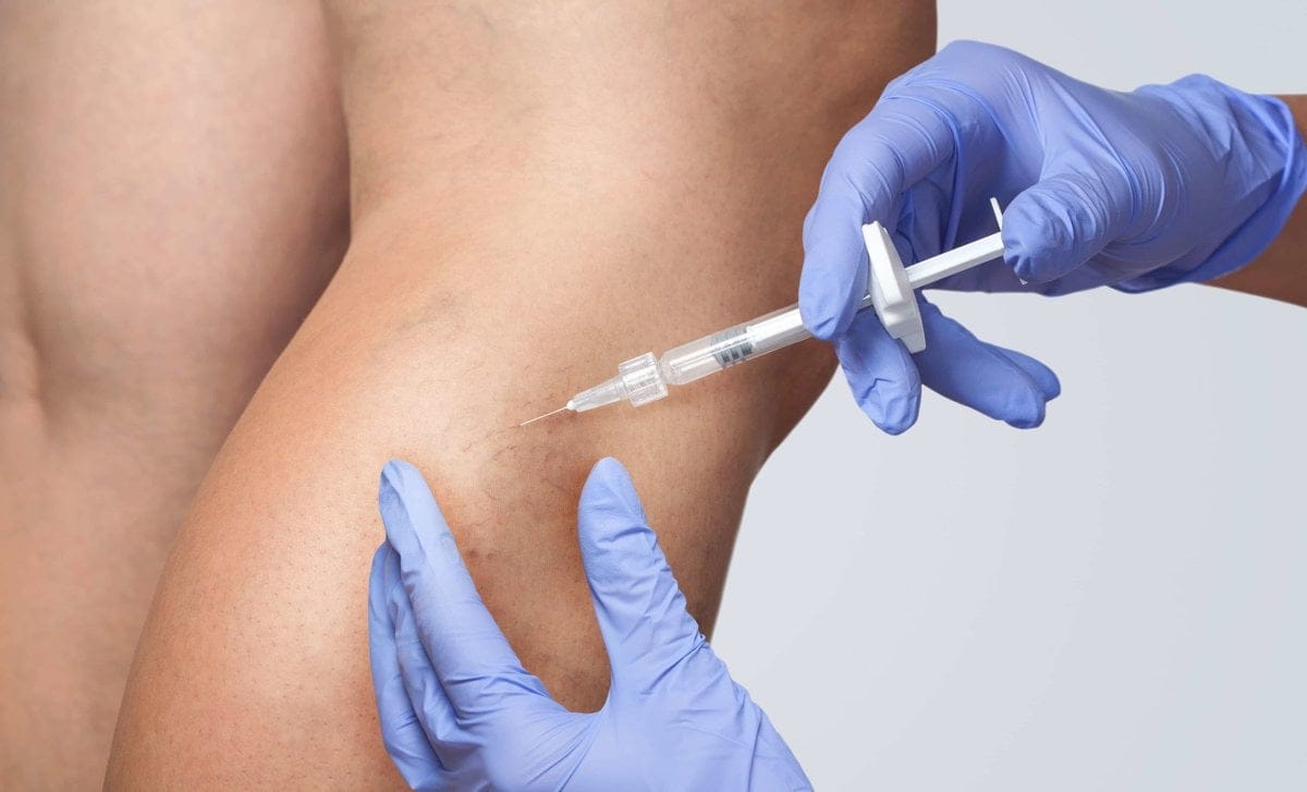 What is Vein Sclerotherapy | Skin Savvy Aesthetics | Franklin, MA