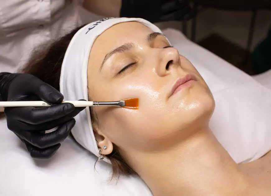 Chemical Peels Treatment by Skin Savvy Medspa in Foxboro, MA