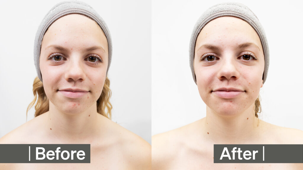 Balanced Skin with Oxygen BHA Before After 30 days