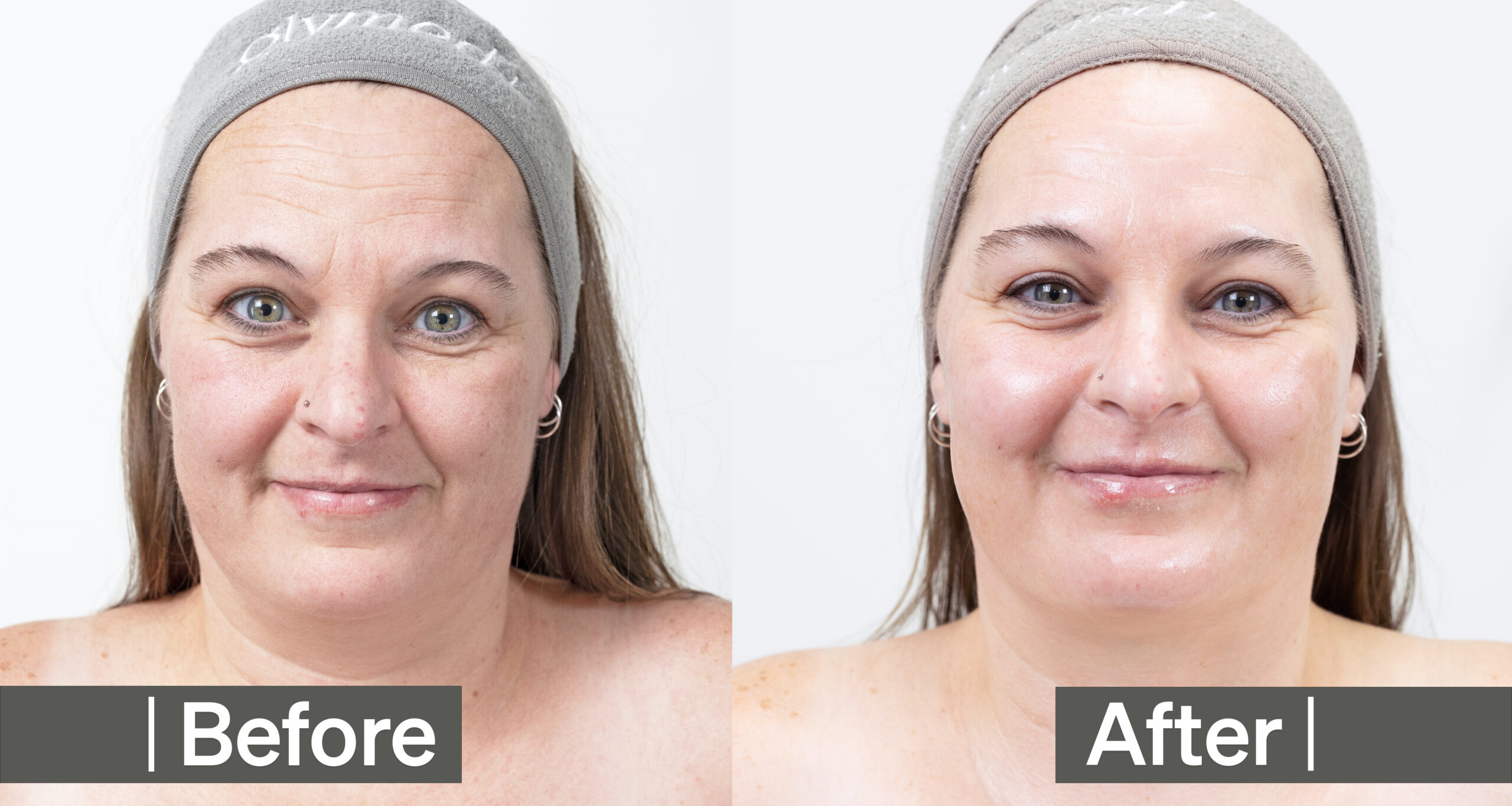 Staci Complete Before After scaled